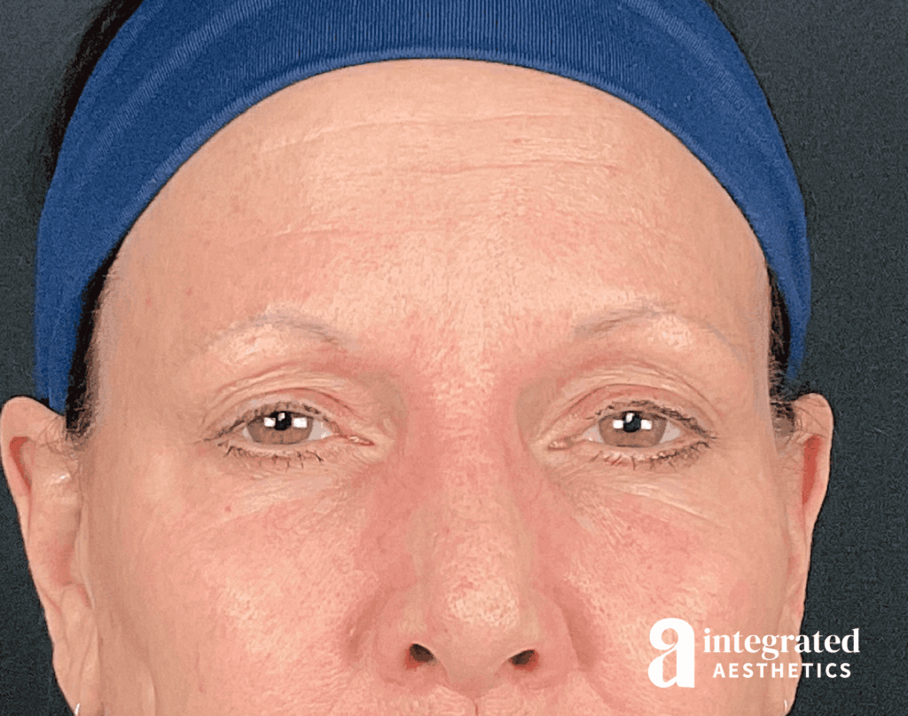 Dermal Fillers