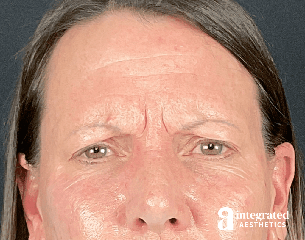Dermal Fillers