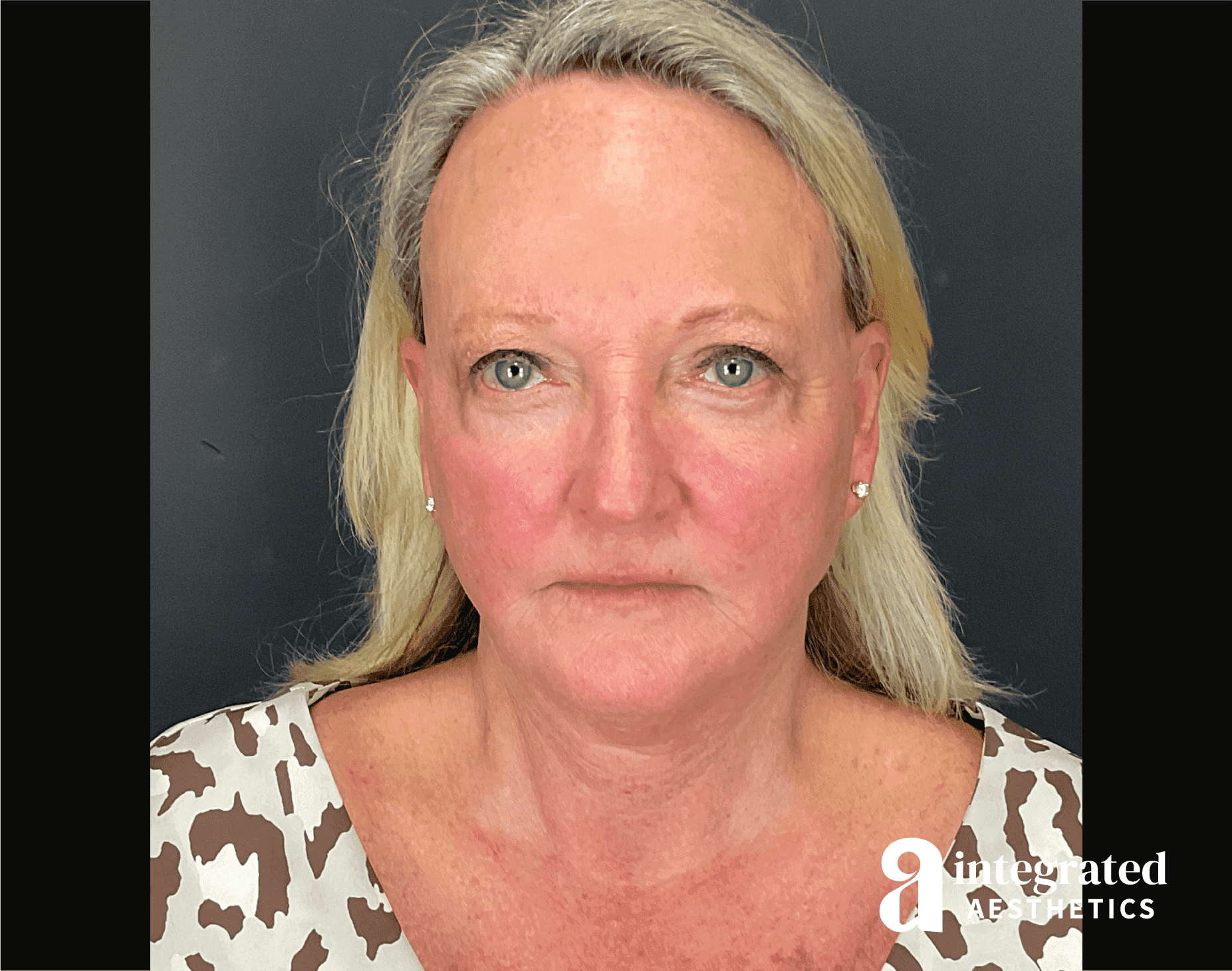 Facelift & Neck Lift