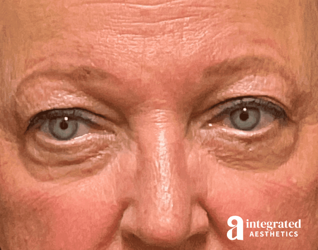 Blepharoplasty