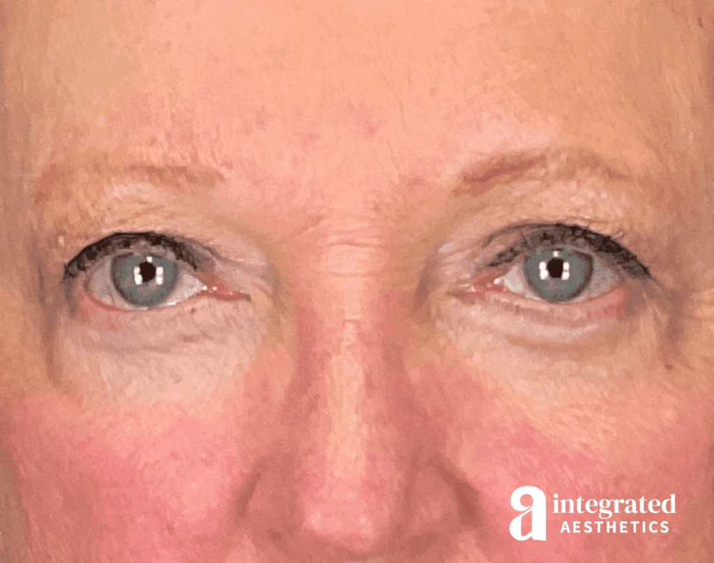 Blepharoplasty