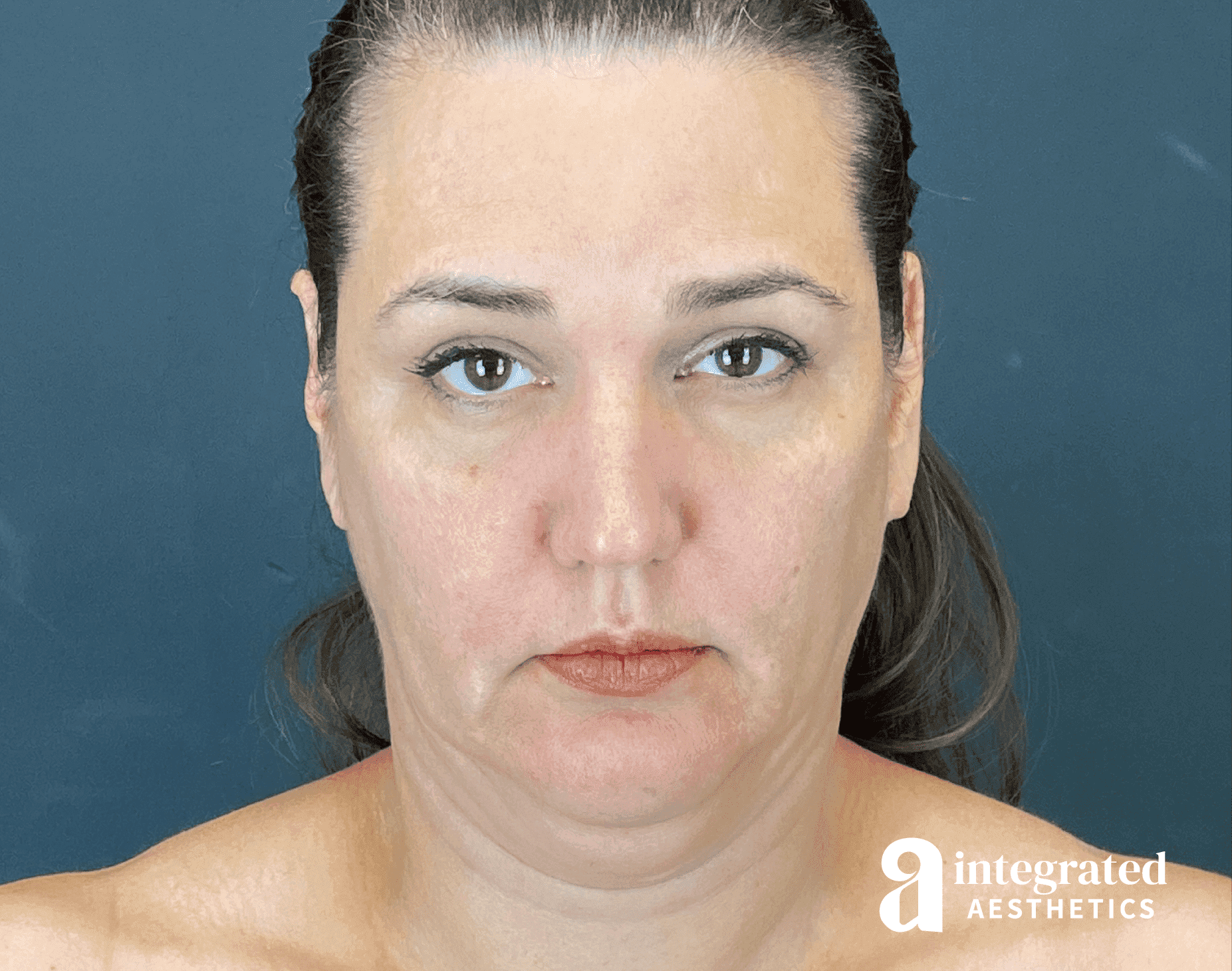 Facelift & Neck Lift