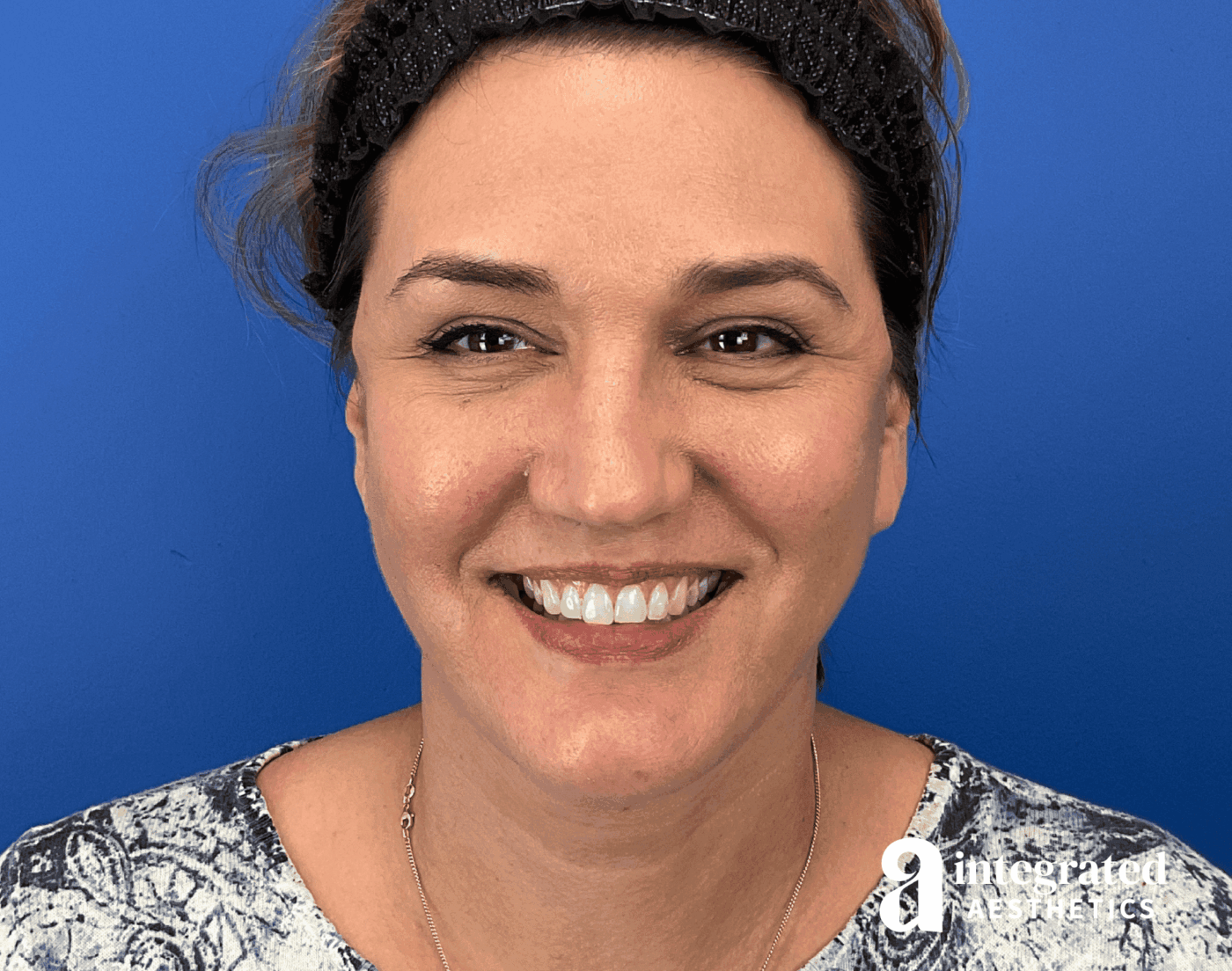 Facelift & Neck Lift