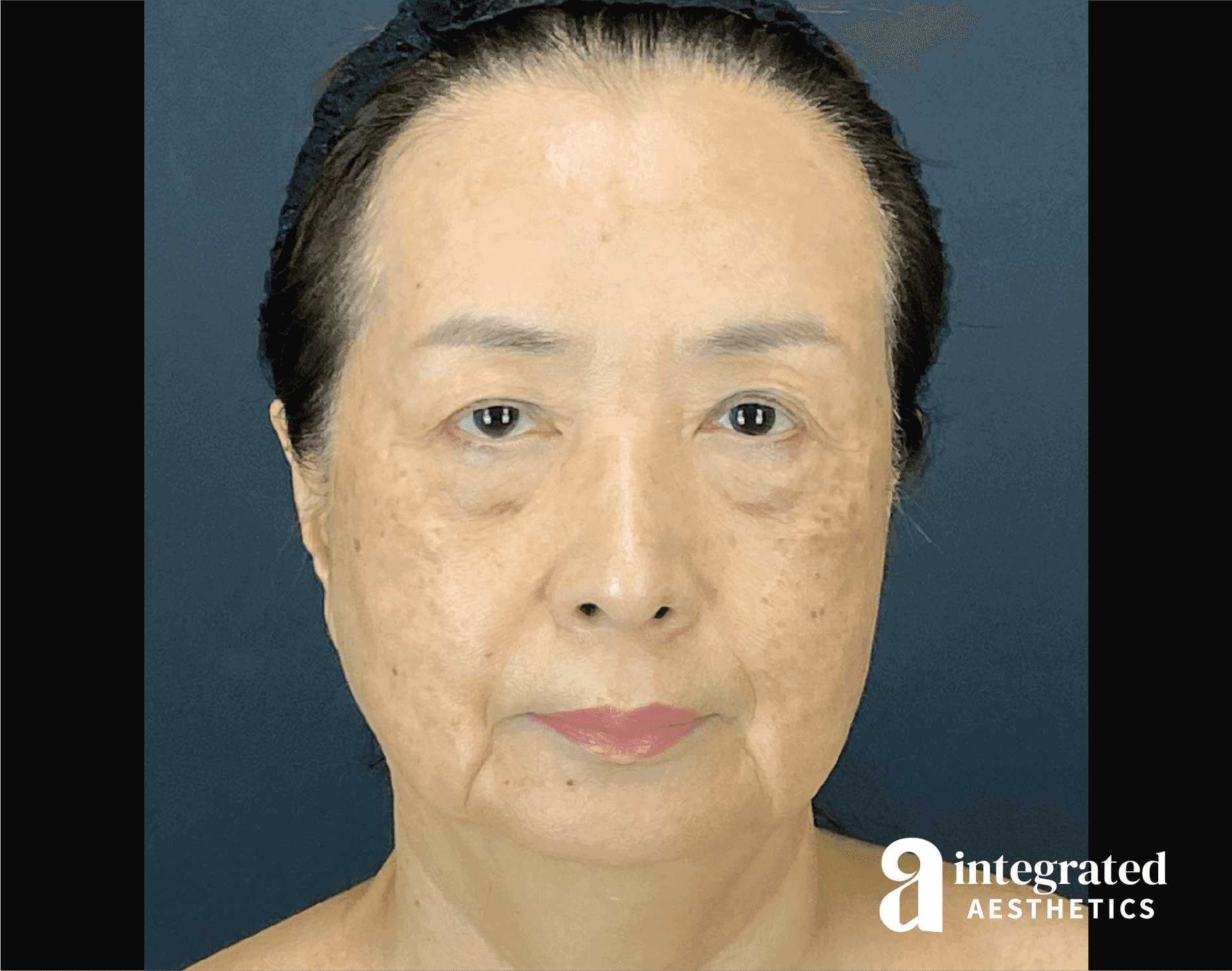 Facelift & Neck Lift