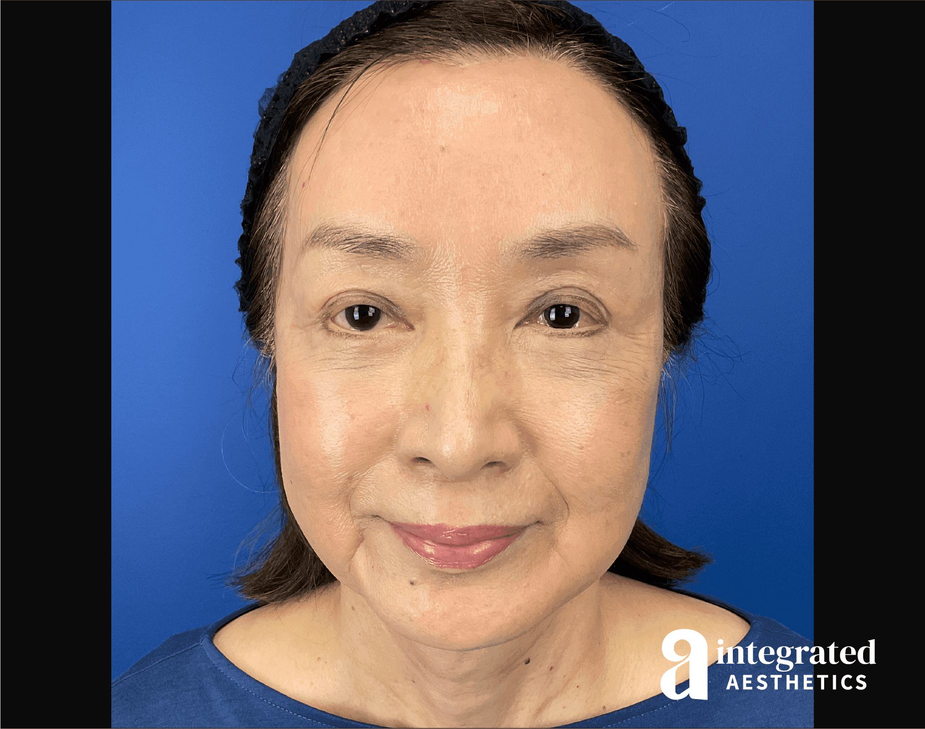Facelift & Neck Lift