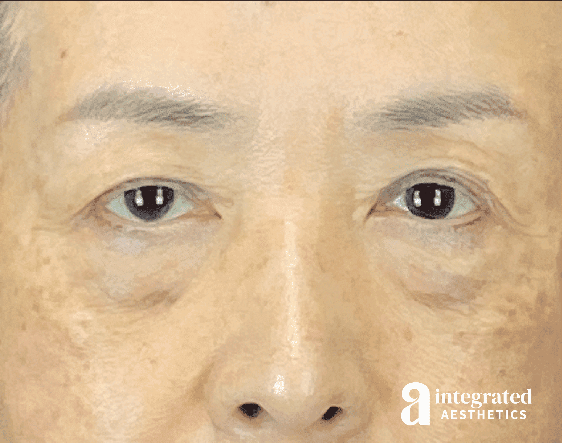Brow Lift