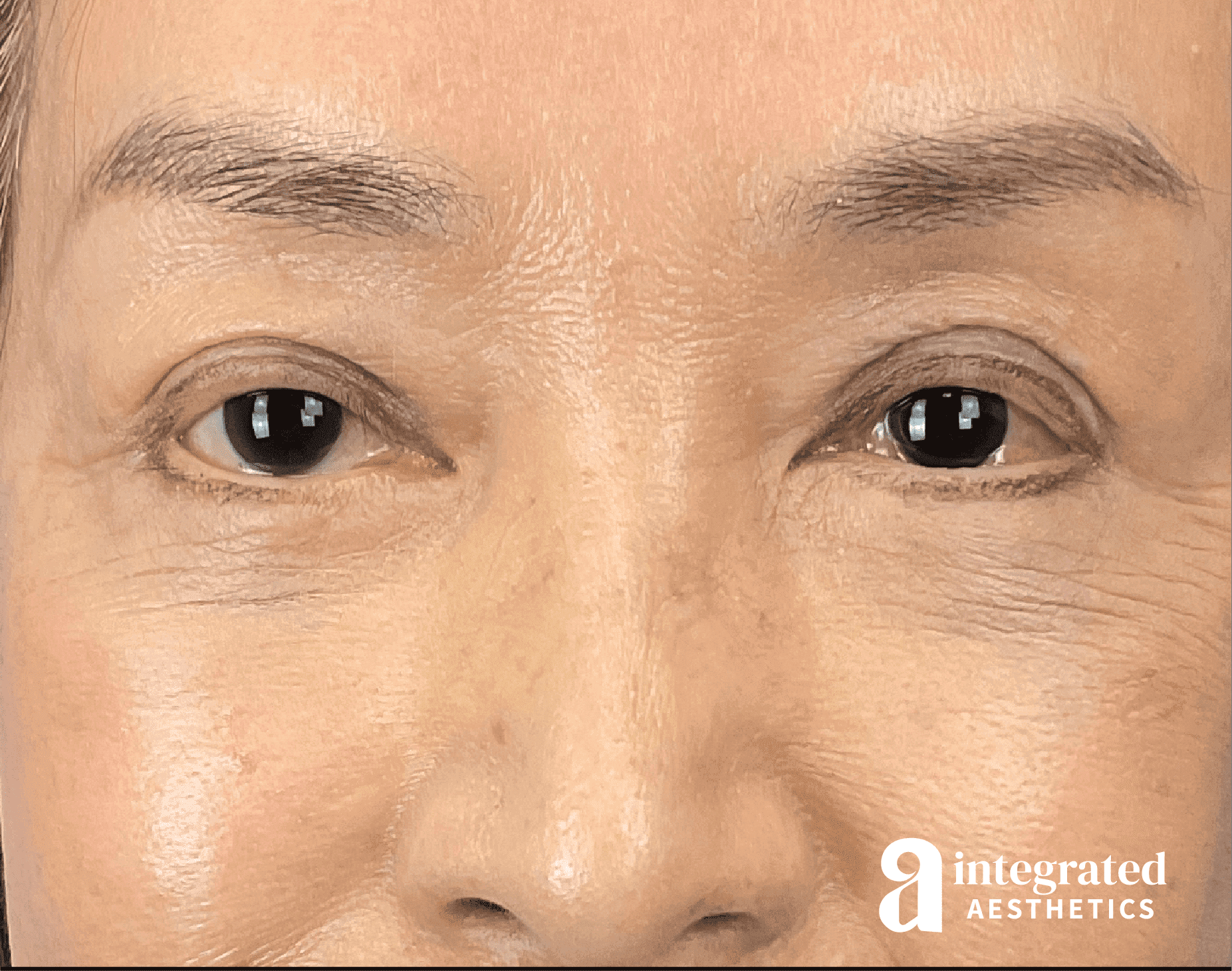 Brow Lift
