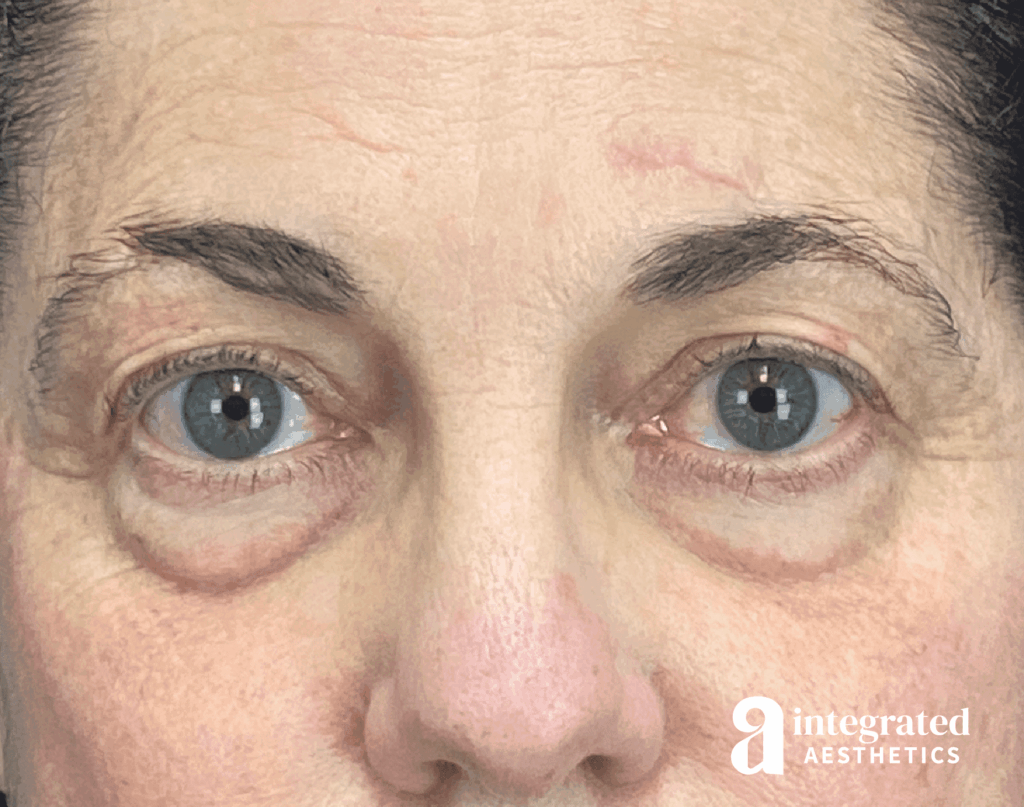 Blepharoplasty