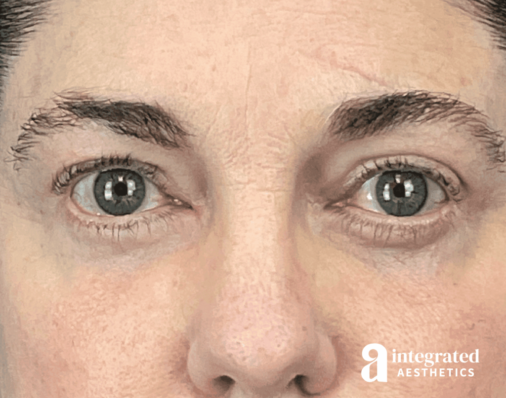 Blepharoplasty