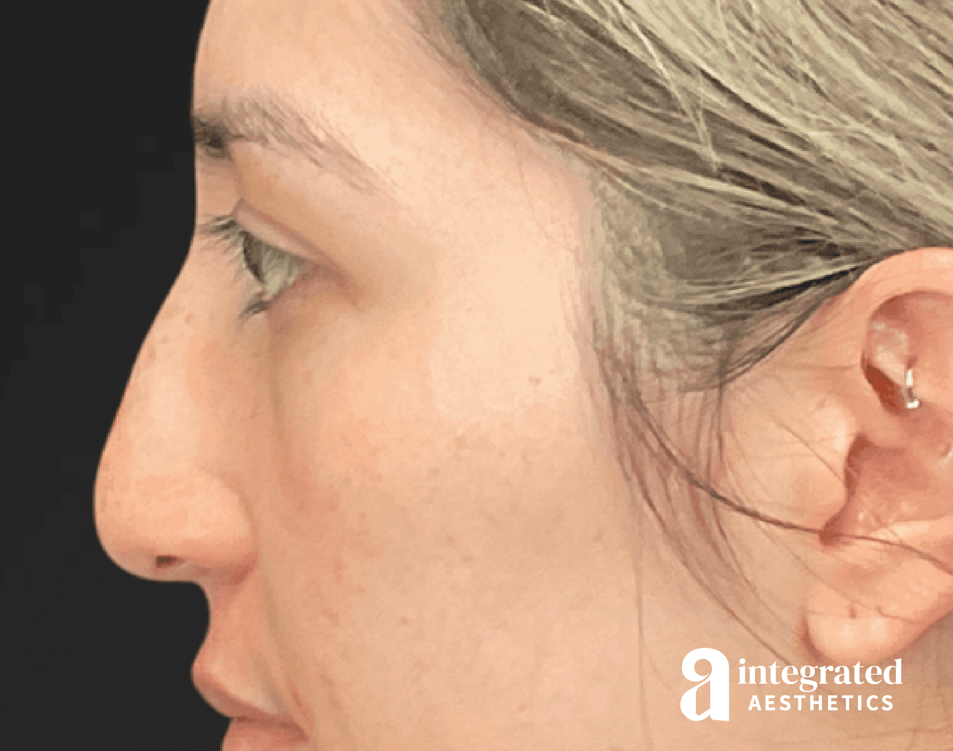 Rhinoplasty