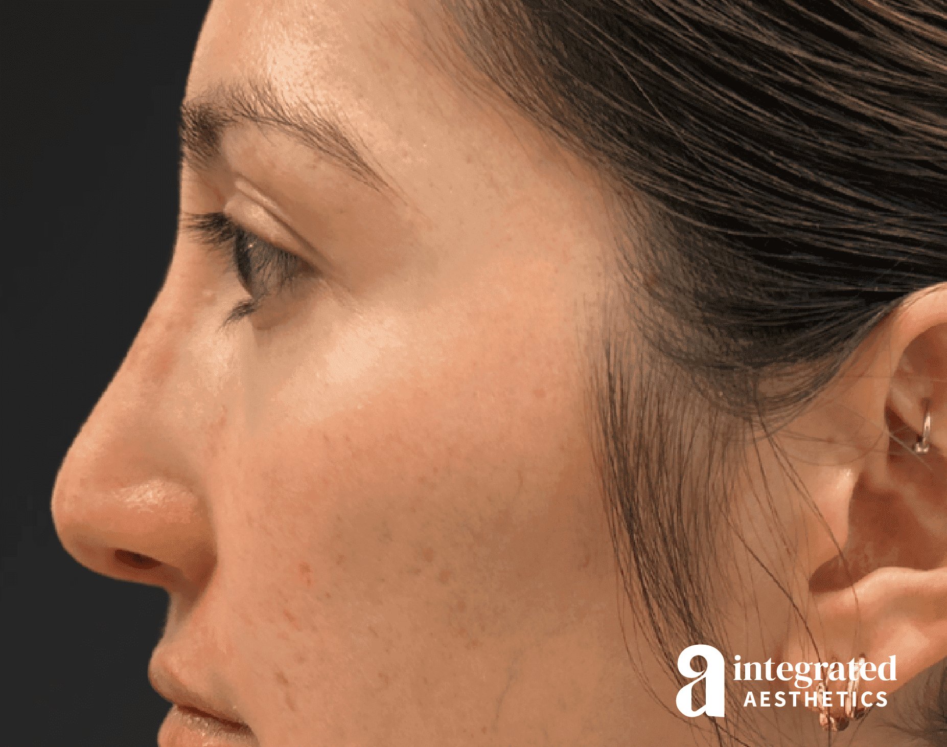 Rhinoplasty