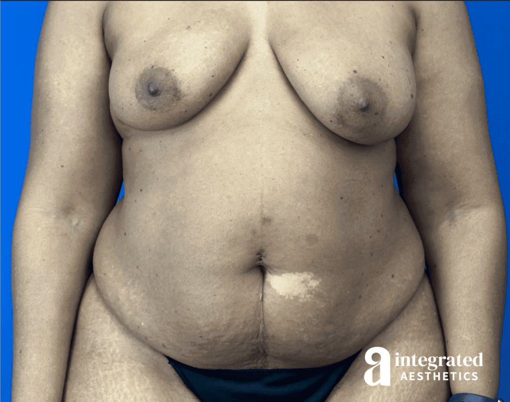 Tummy Tuck