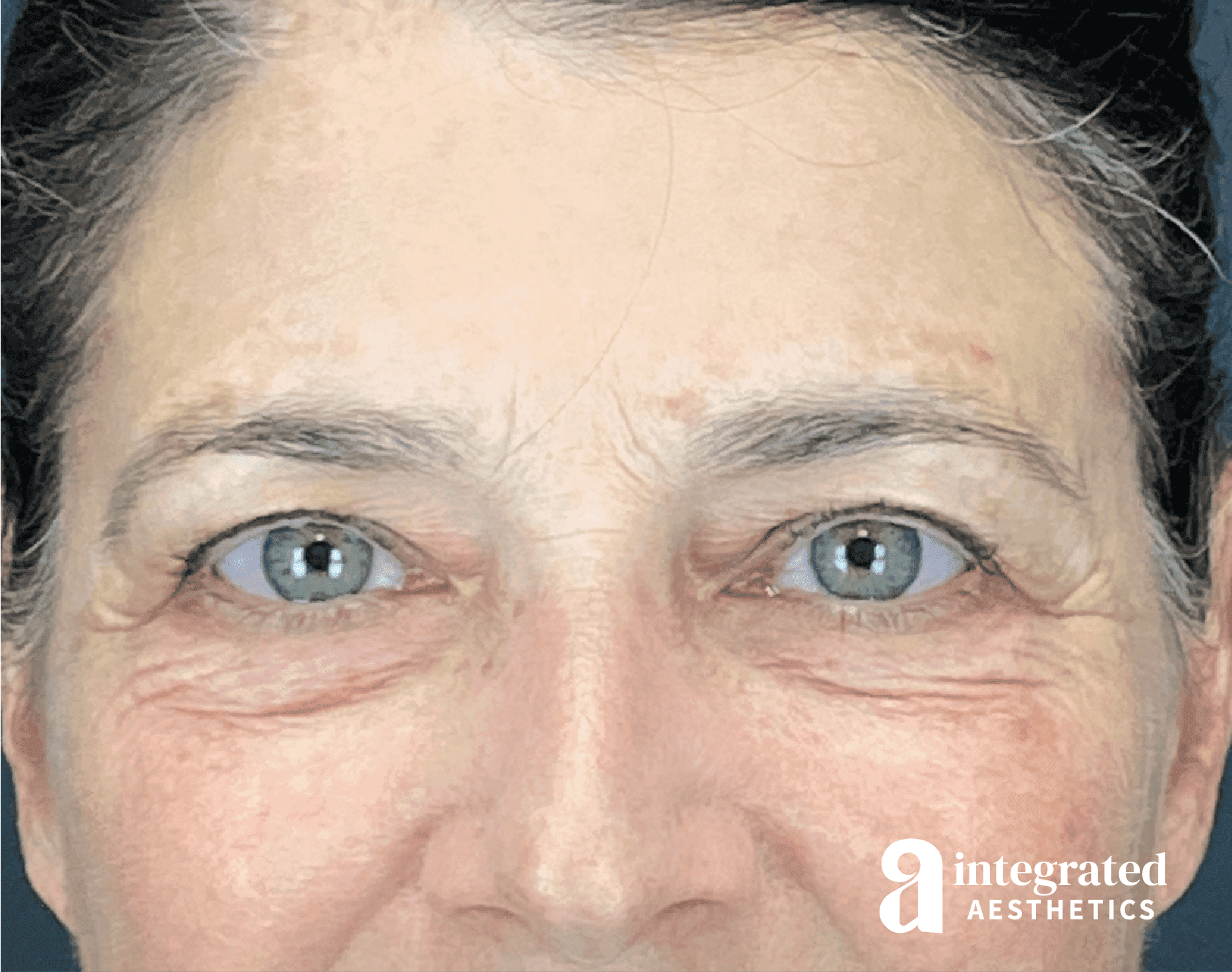 Blepharoplasty