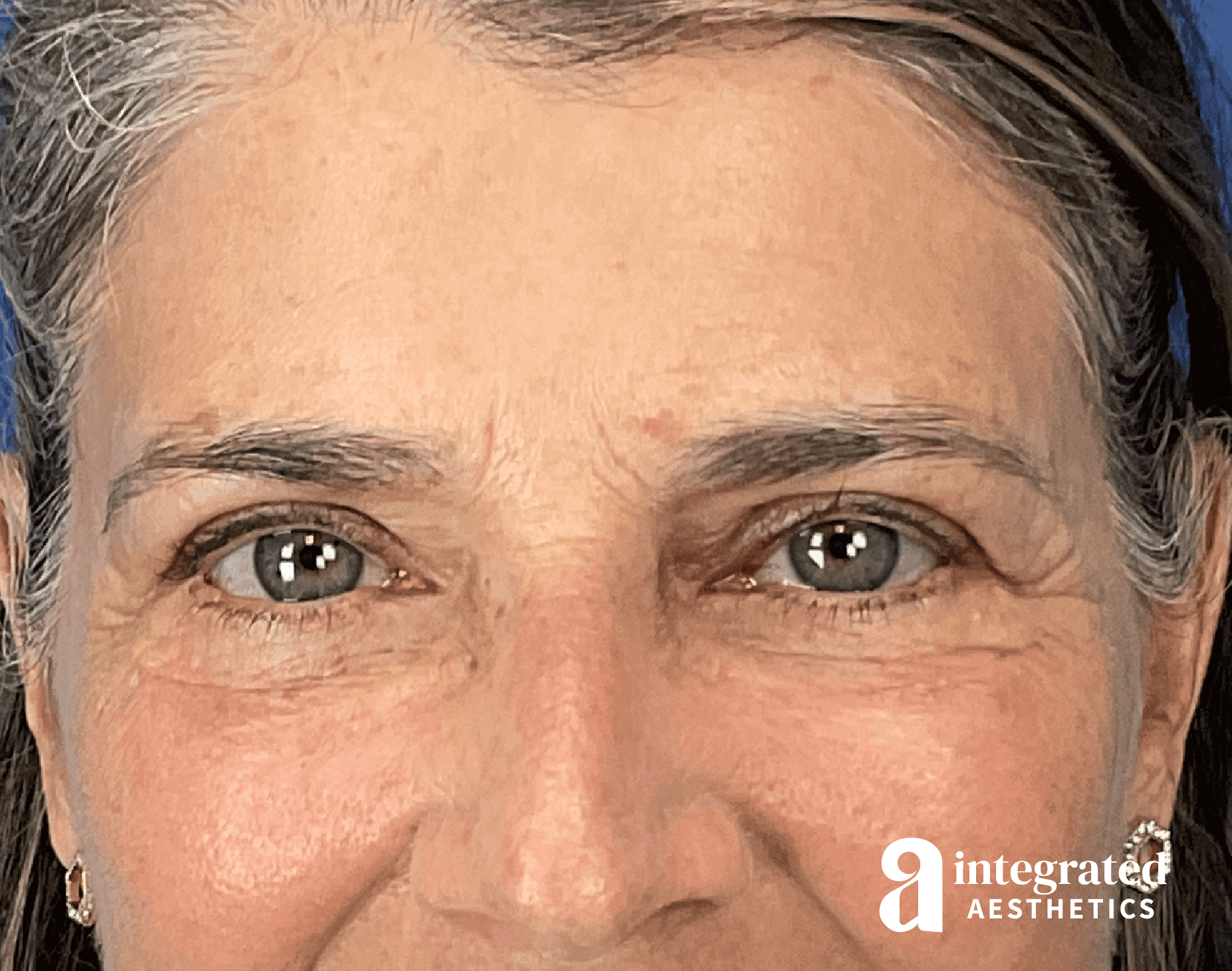 Blepharoplasty