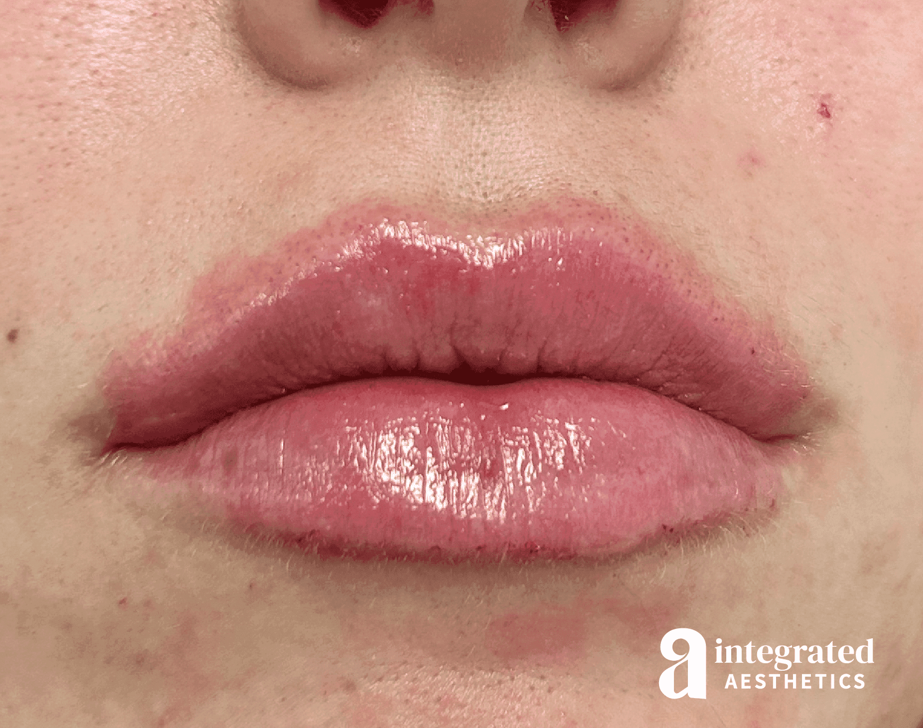 Lip Filler