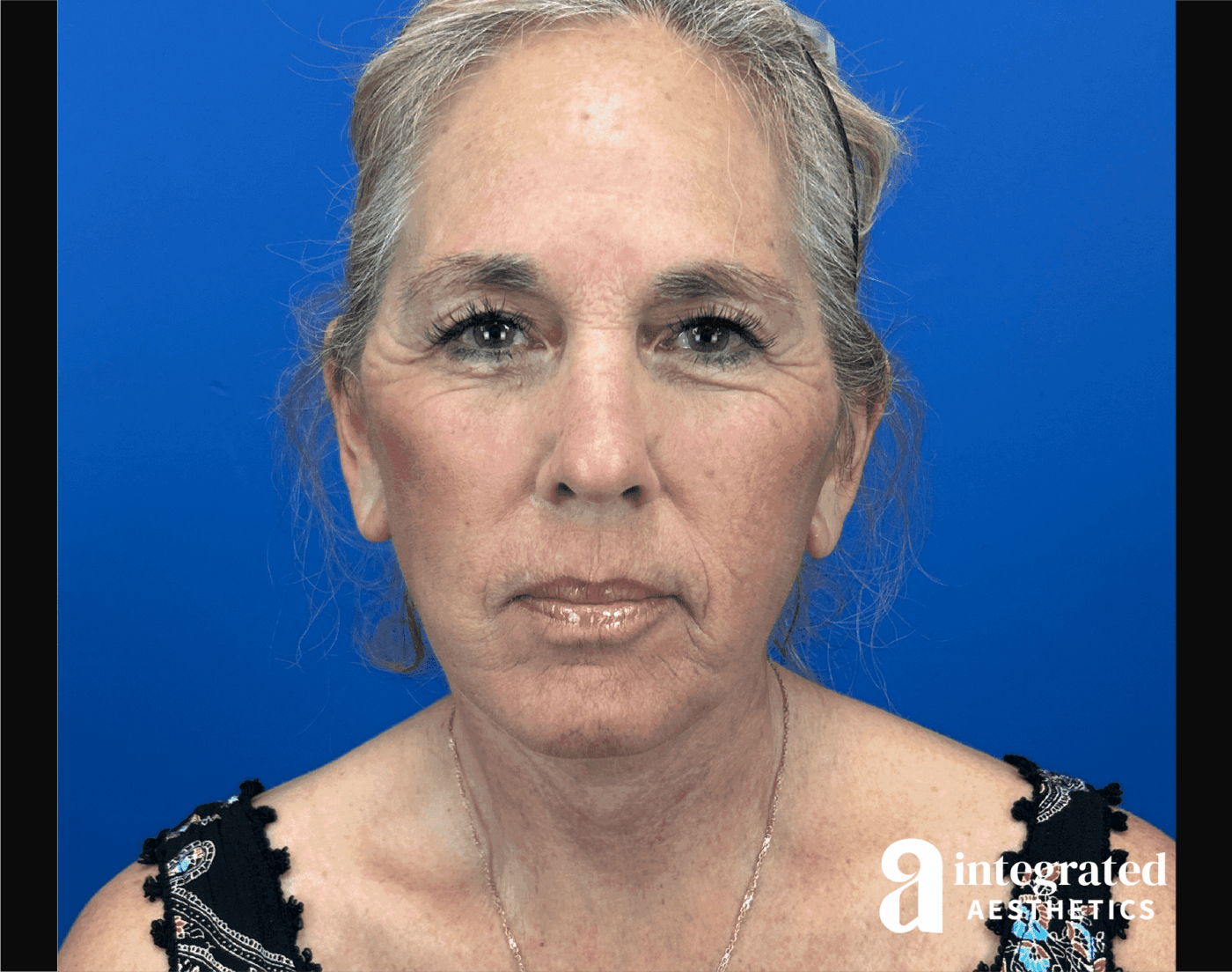 Facelift & Neck Lift