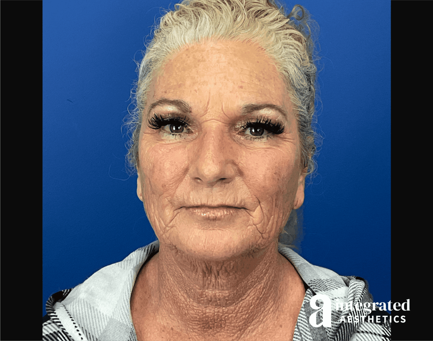 Facelift & Neck Lift Before & After Gallery - Patient 341686 - Image 1