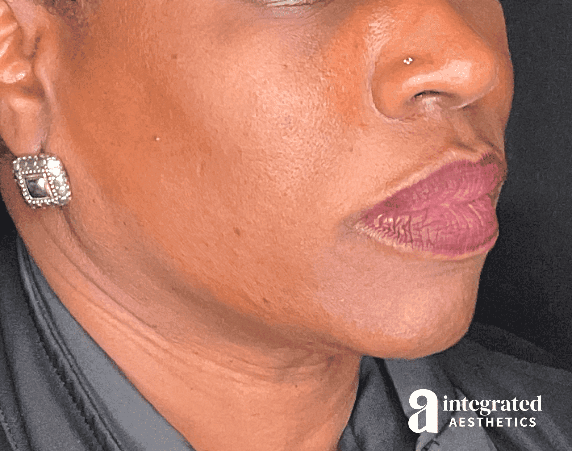 Dermal Fillers