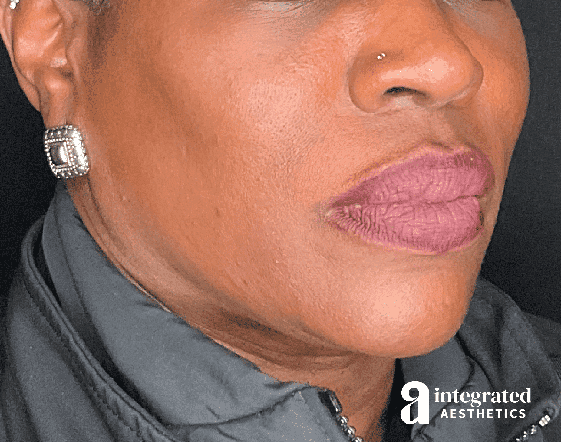 Dermal Fillers