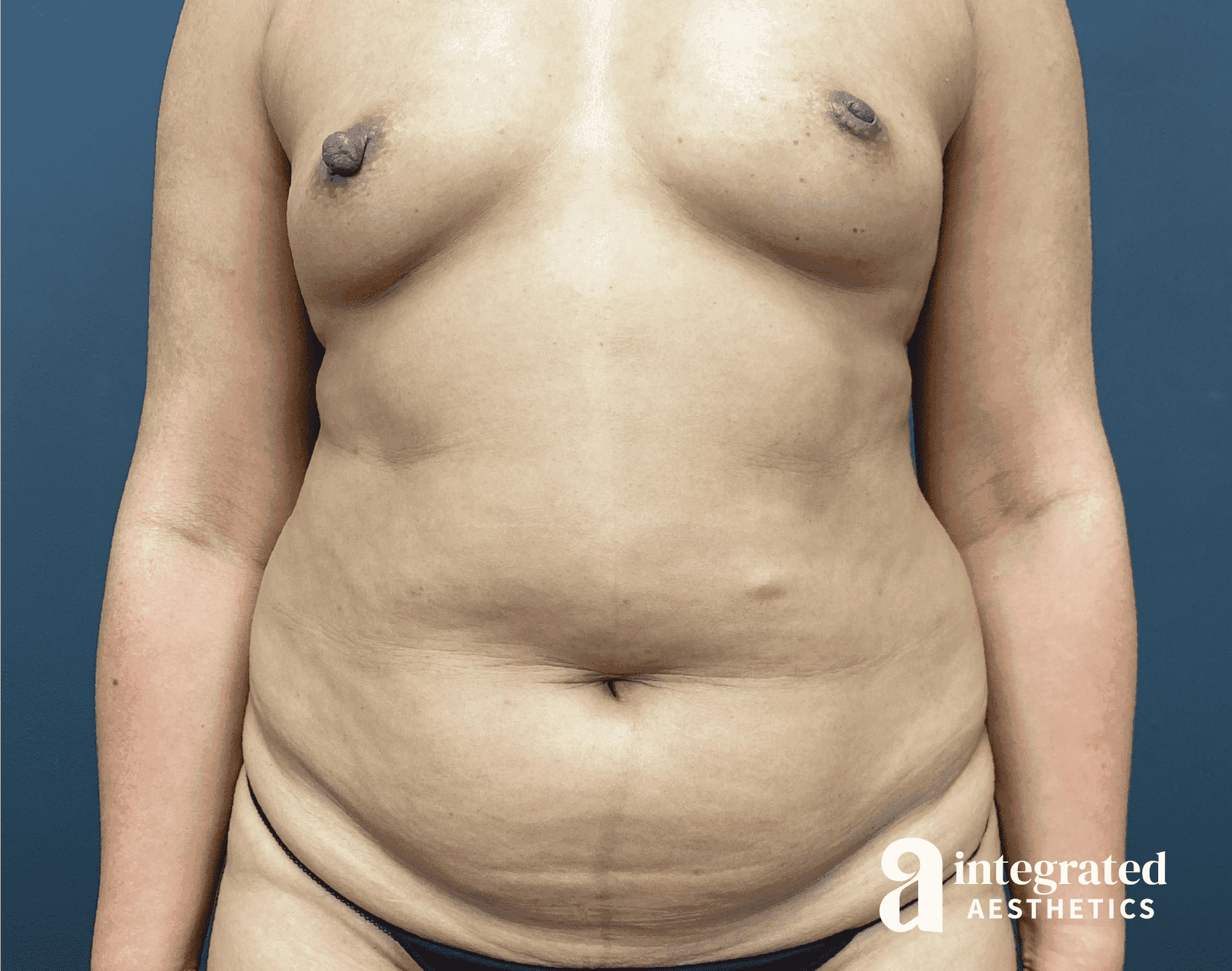 Tummy Tuck