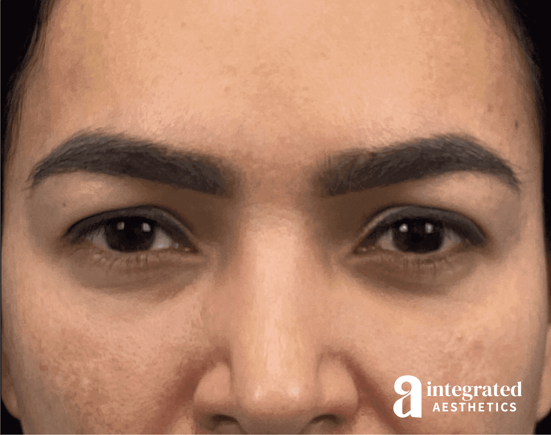 Brow Lift