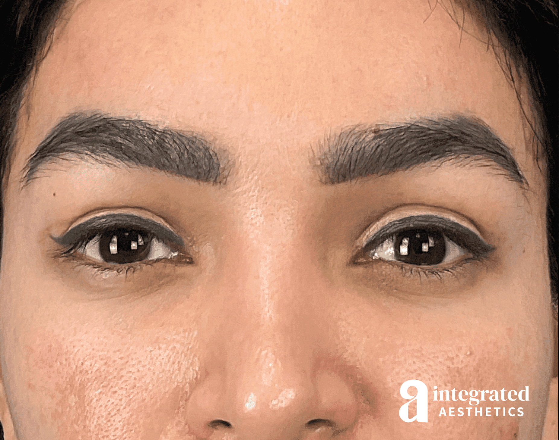 Blepharoplasty
