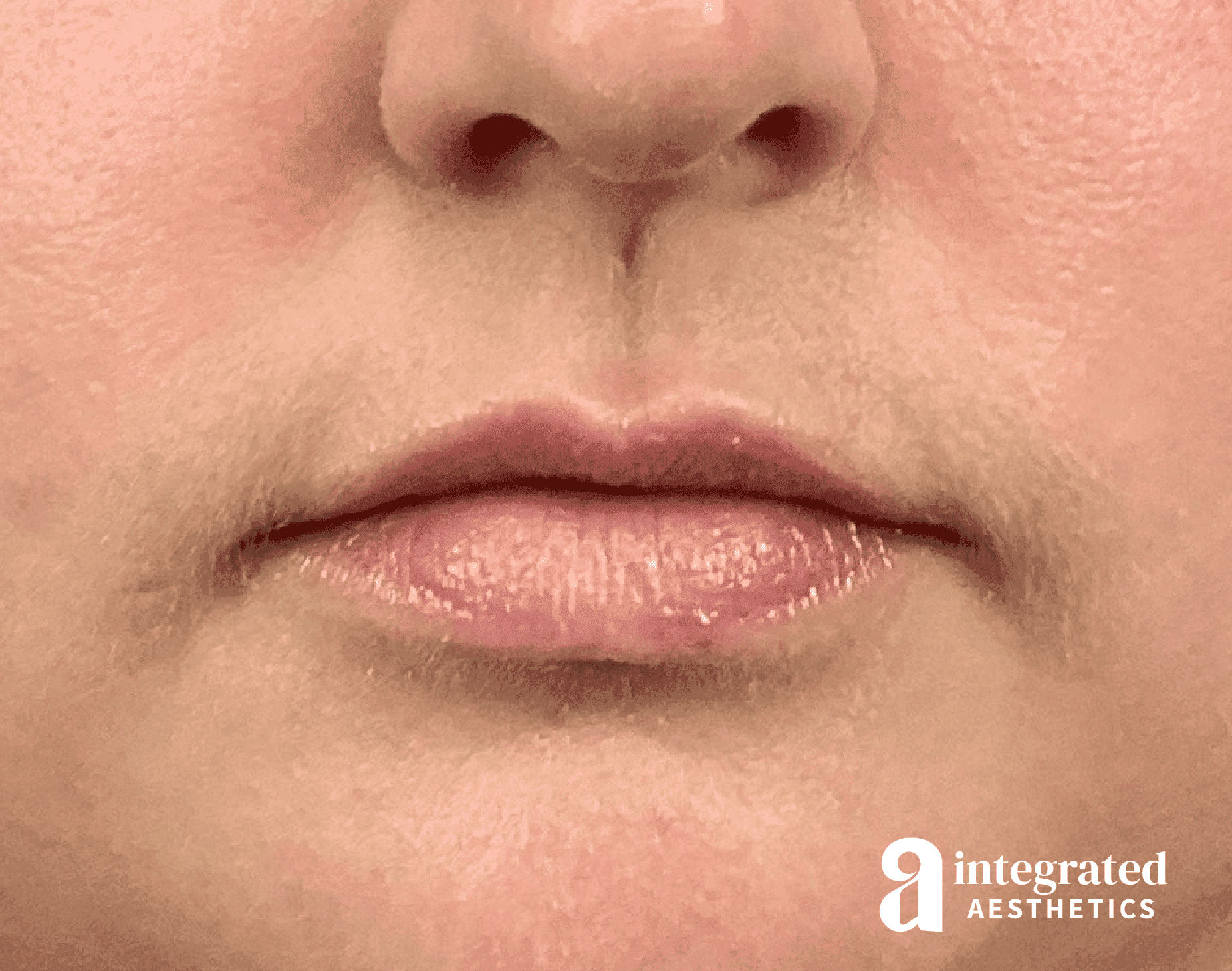 Lip Filler