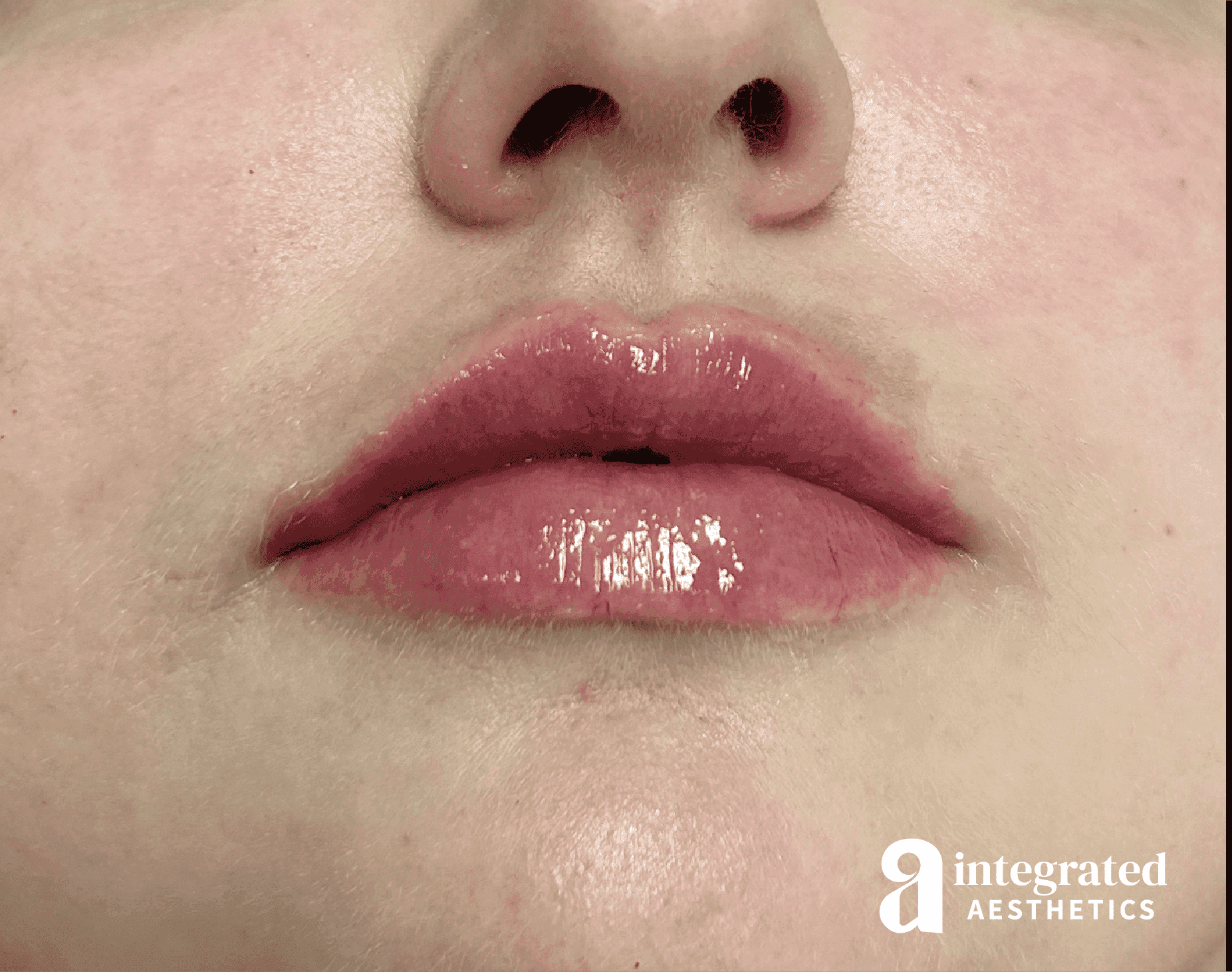 Lip Filler