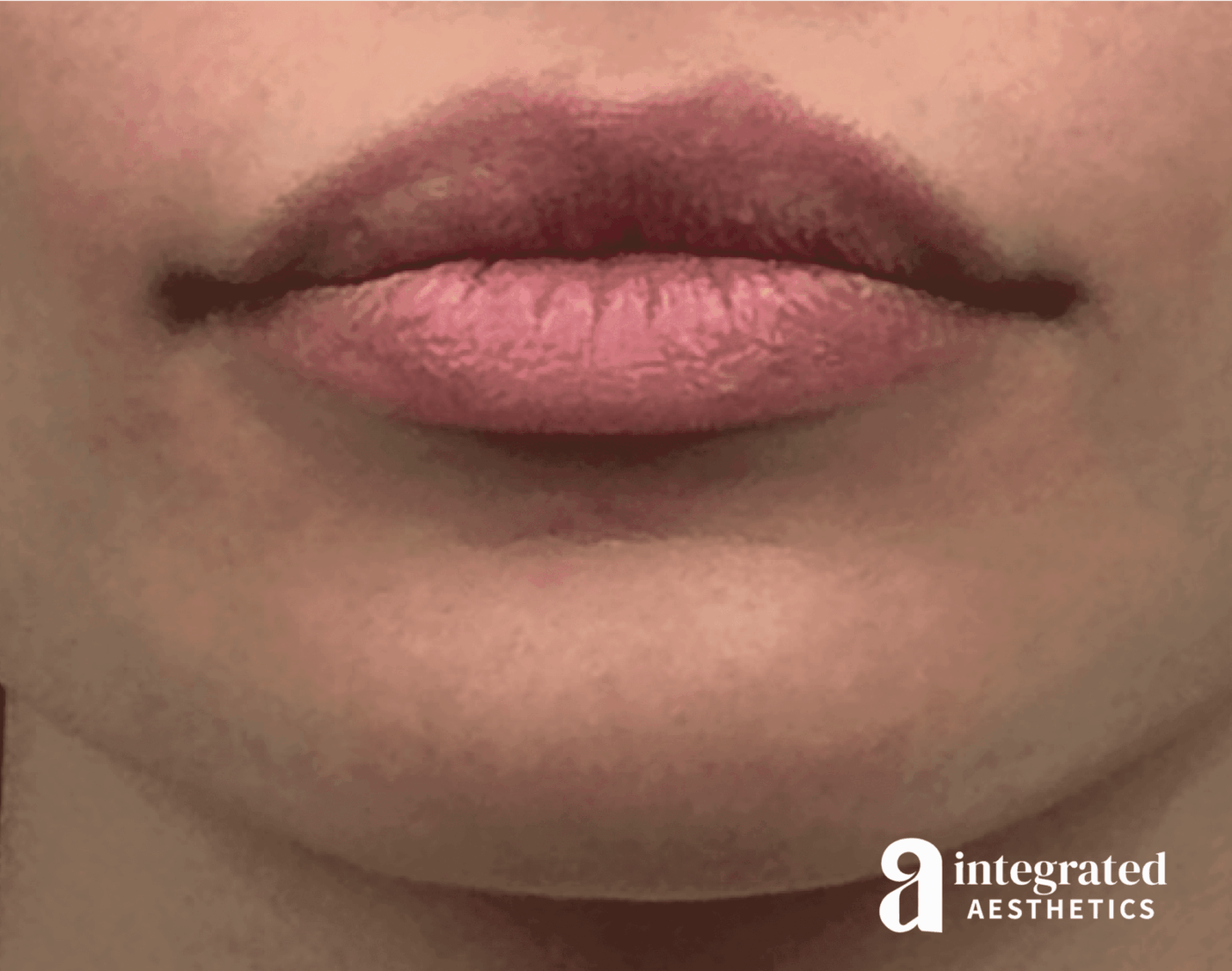Lip Lift Before & After Gallery - Patient 175677 - Image 1