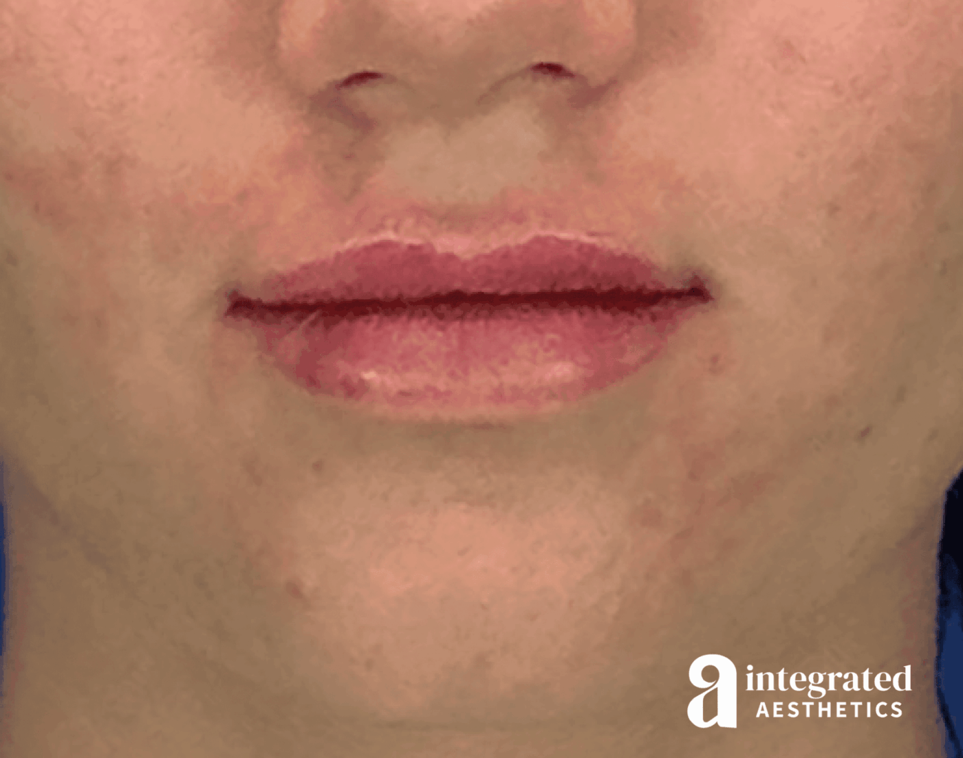 Lip Filler