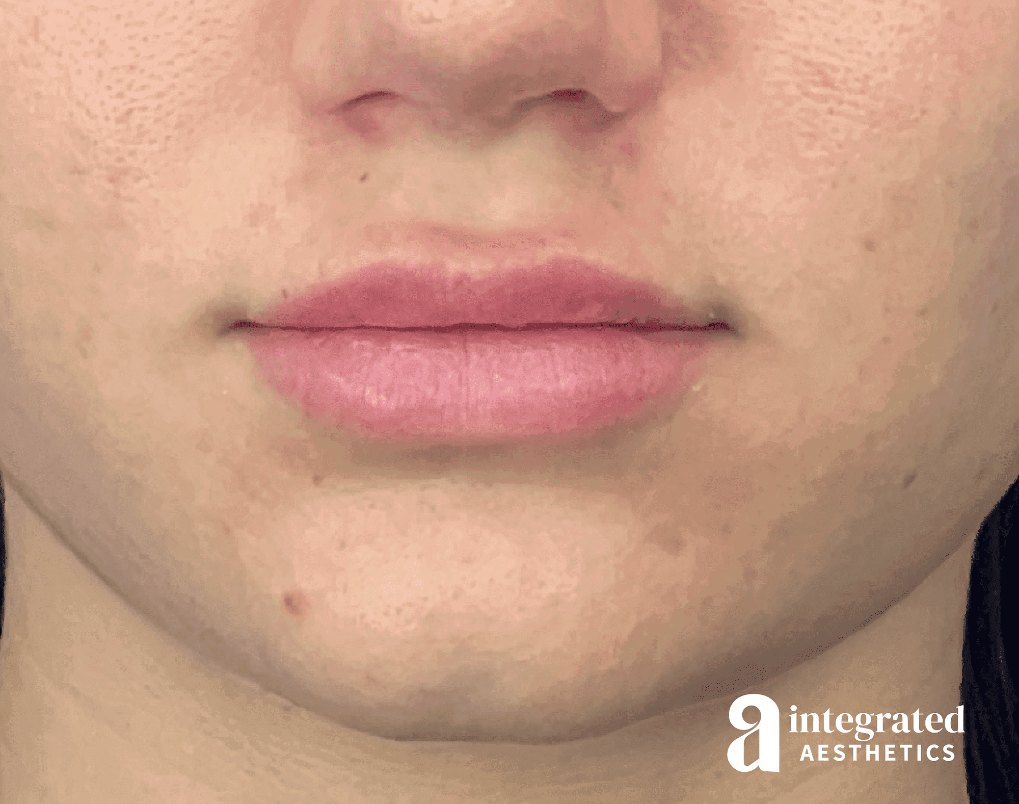 Lip Filler