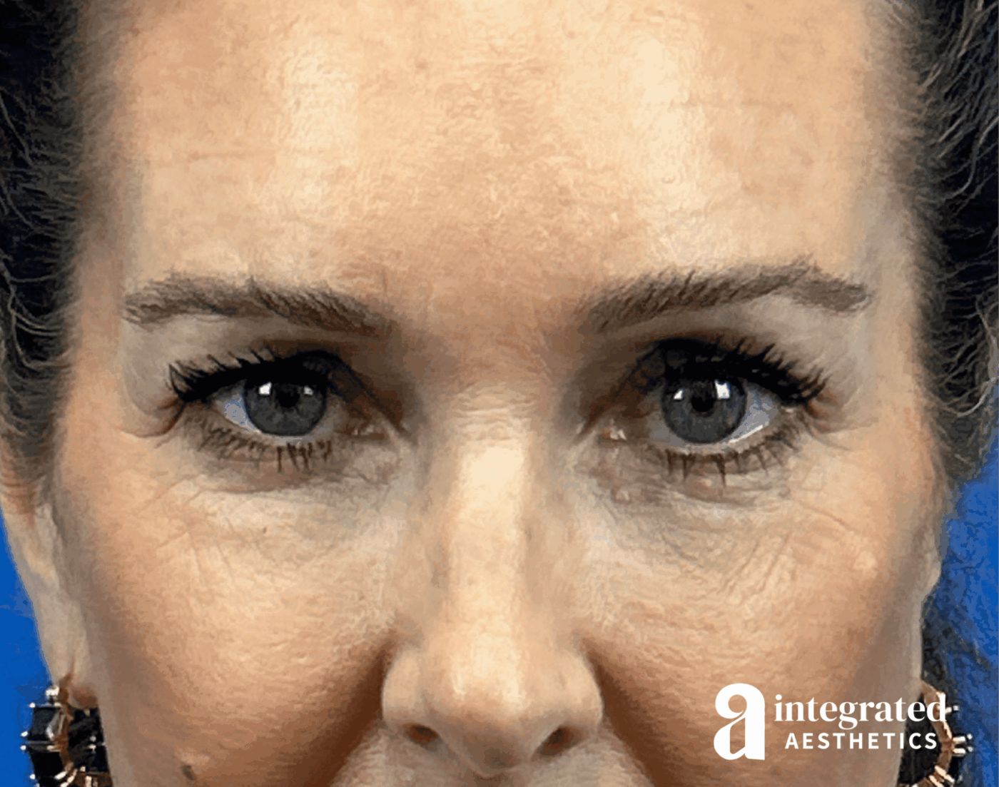 Blepharoplasty