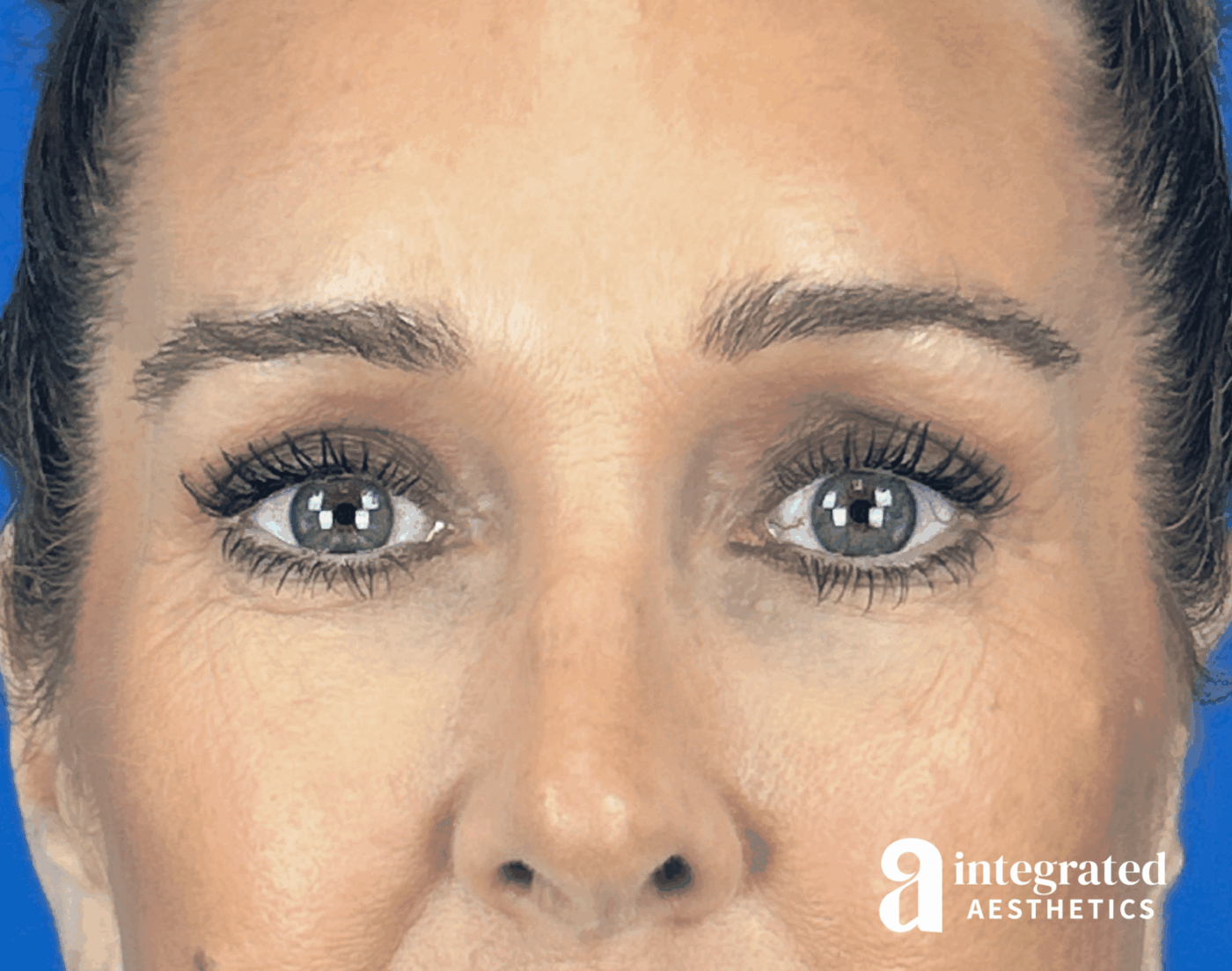 Blepharoplasty