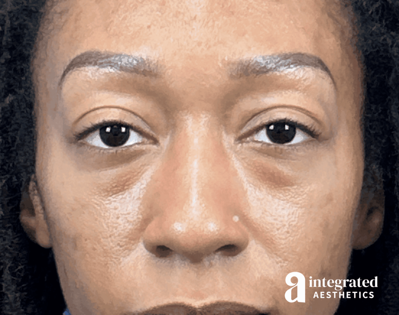Blepharoplasty