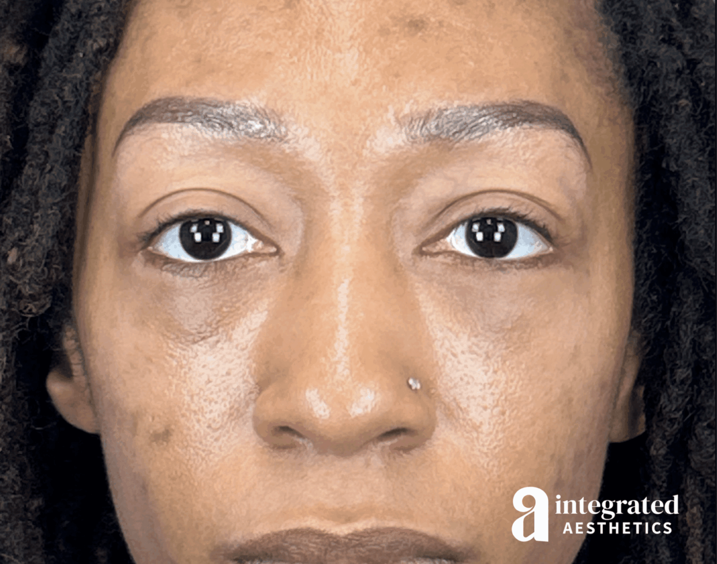 Blepharoplasty