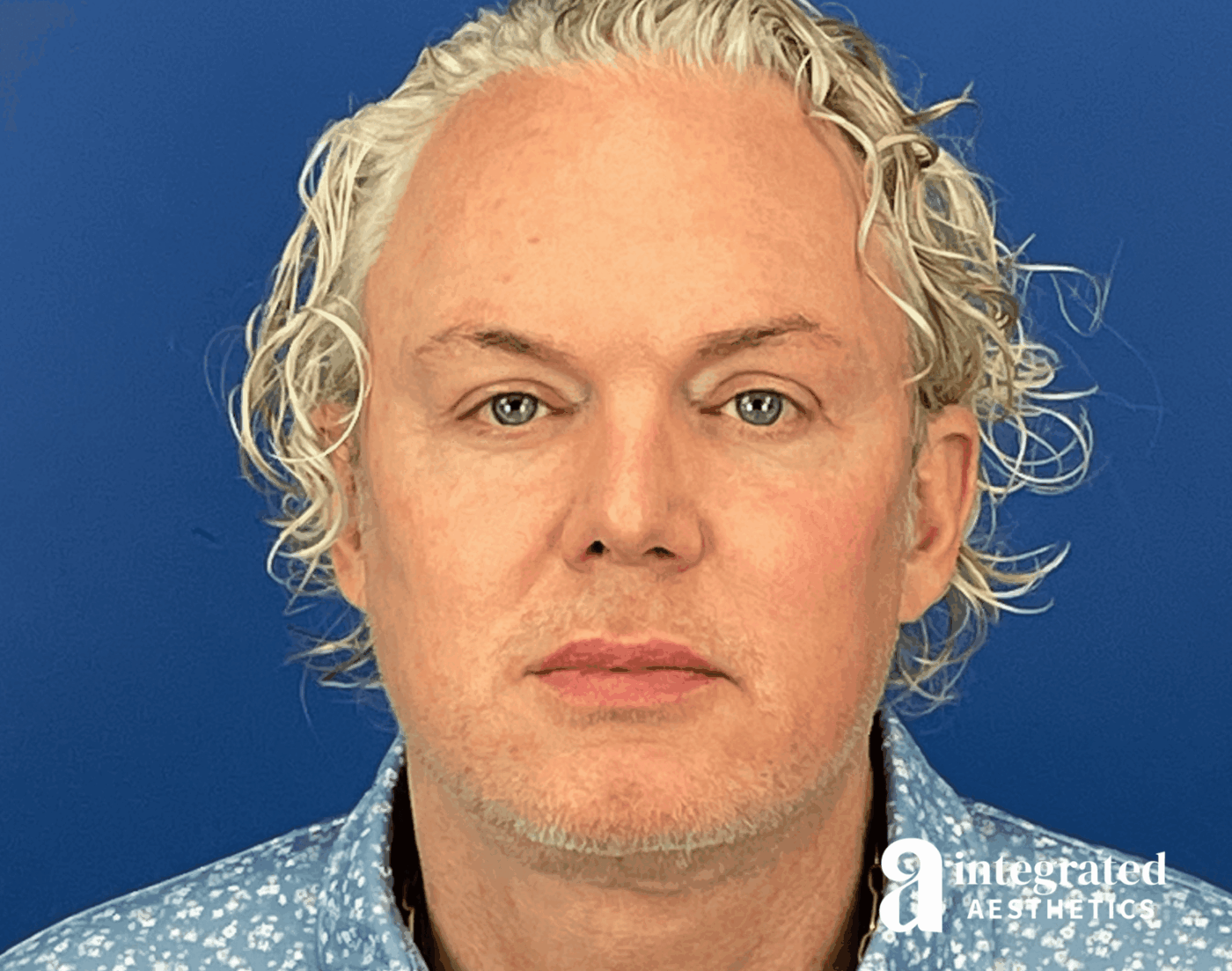 Facelift & Neck Lift