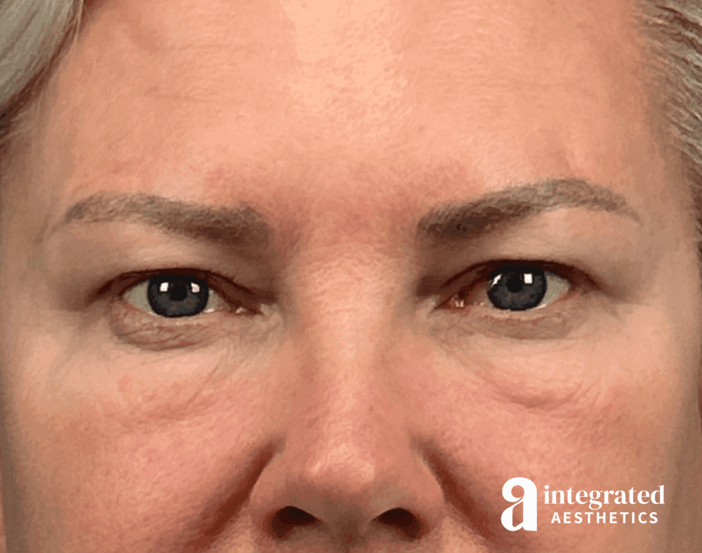 Blepharoplasty