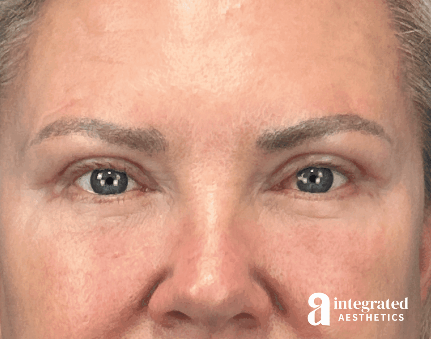 Blepharoplasty