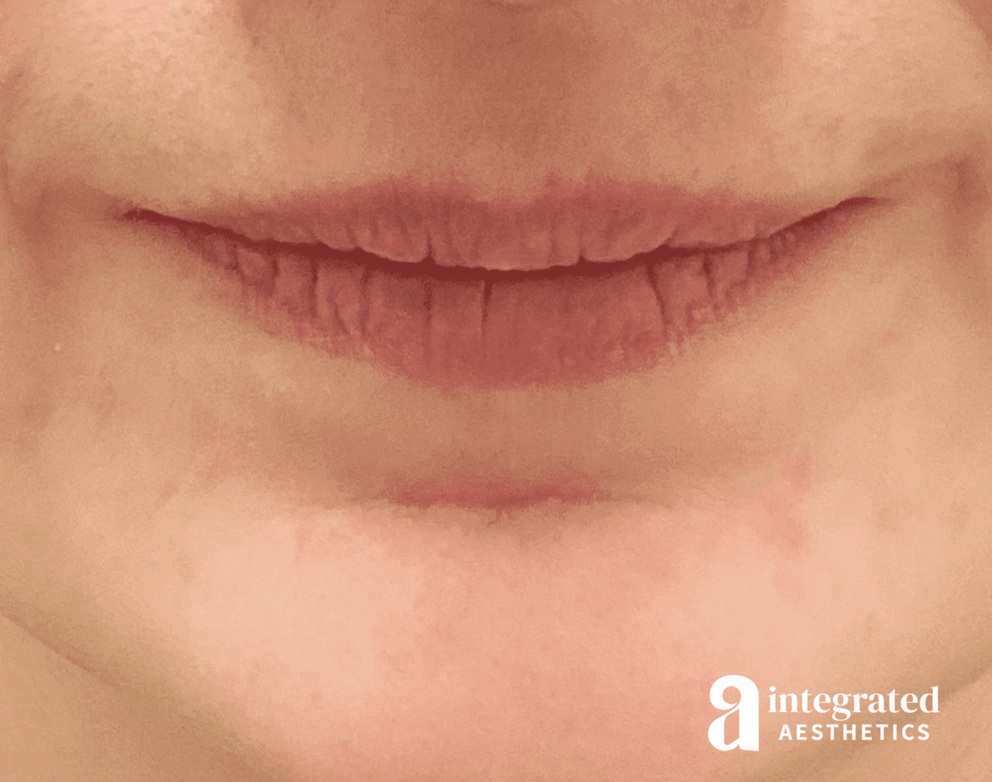 Lip Filler