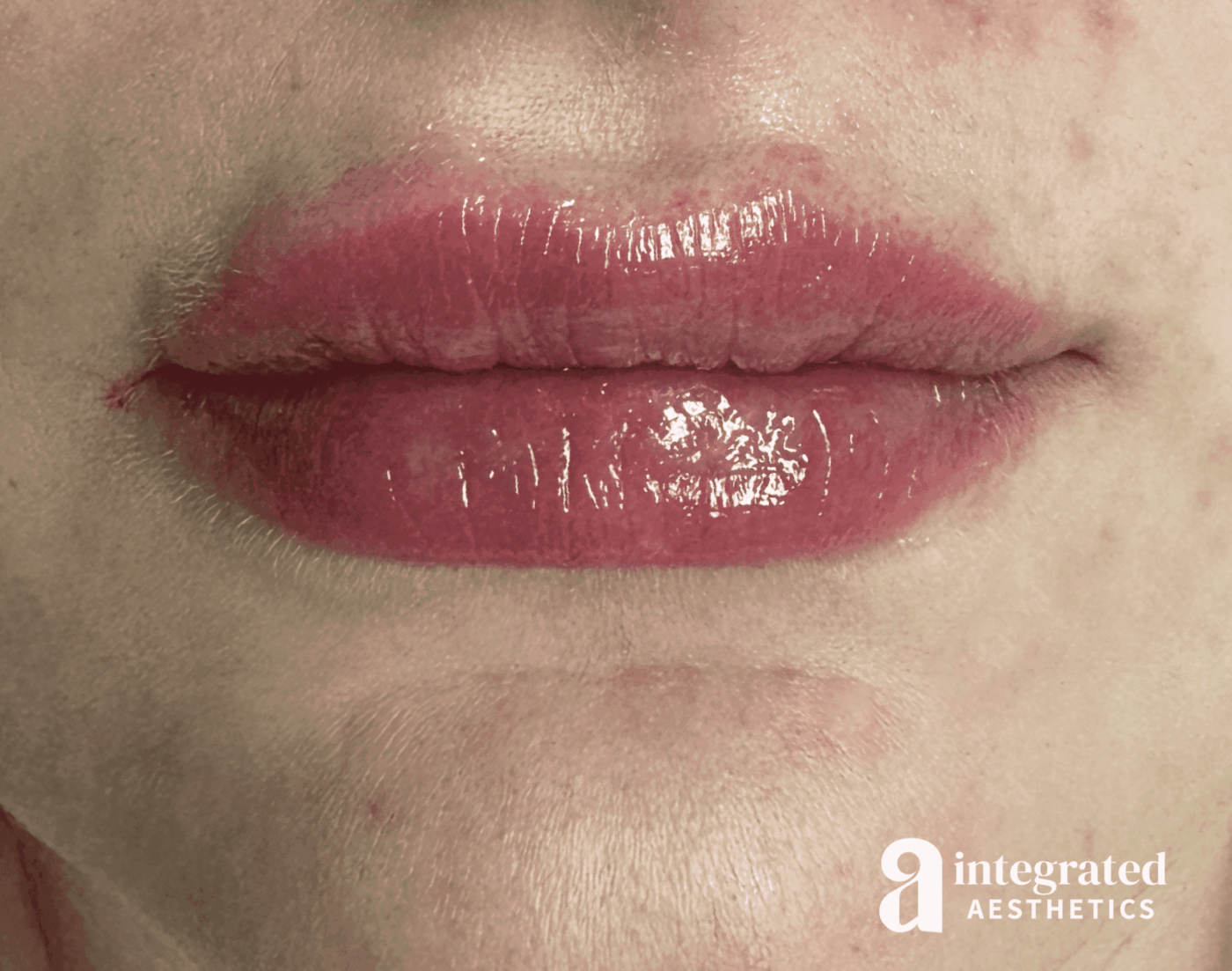Lip Filler