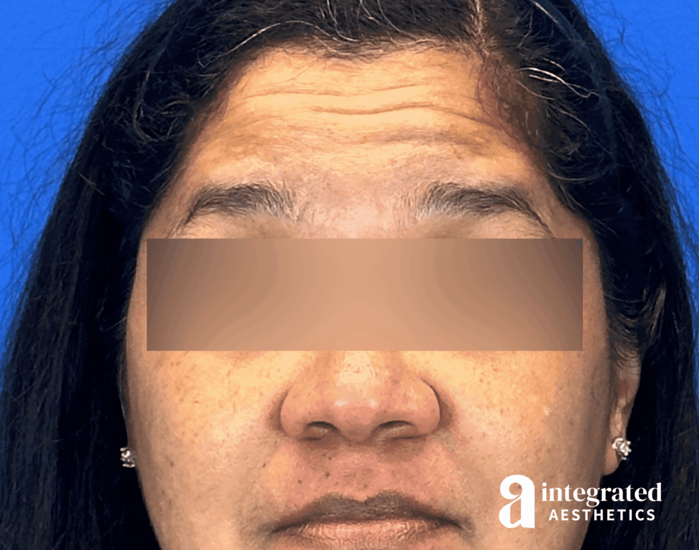 Botox Before & After Gallery - Patient 131184 - Image 1