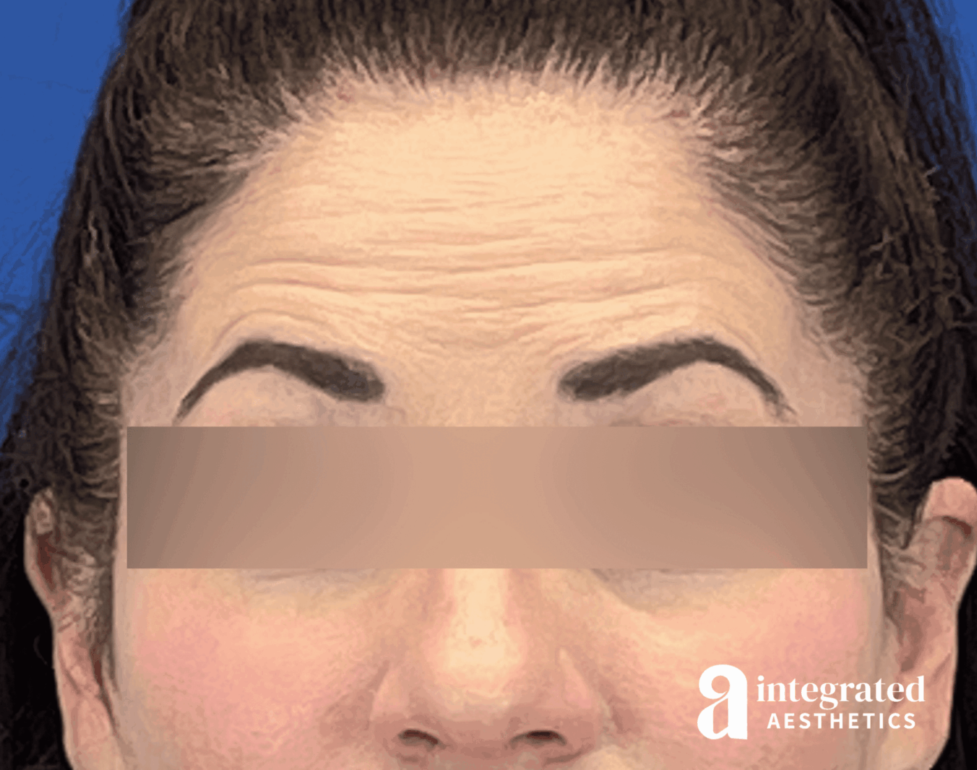Botox Before & After Gallery - Patient 278872 - Image 1