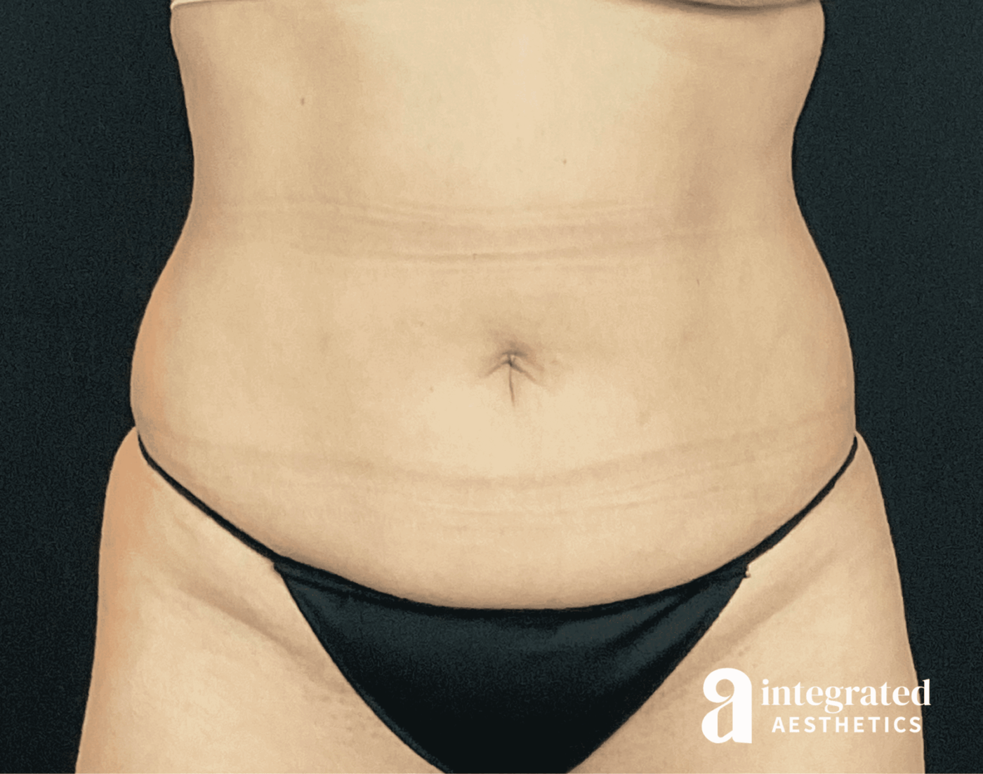 Tummy Tuck