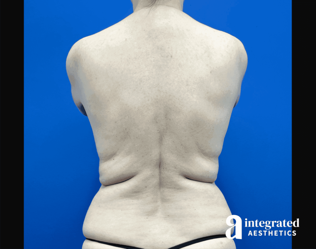Liposuction