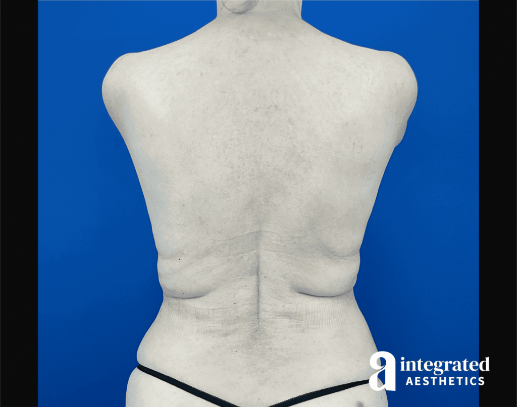 Liposuction