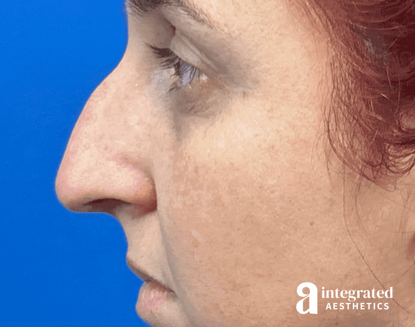 Rhinoplasty