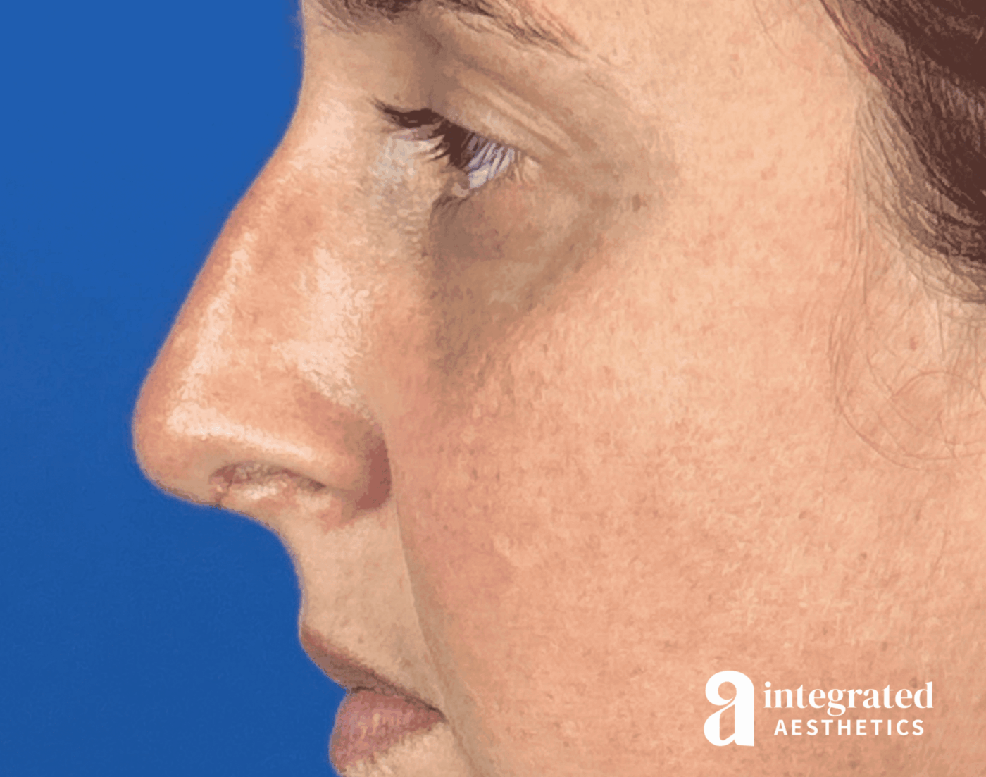 Rhinoplasty