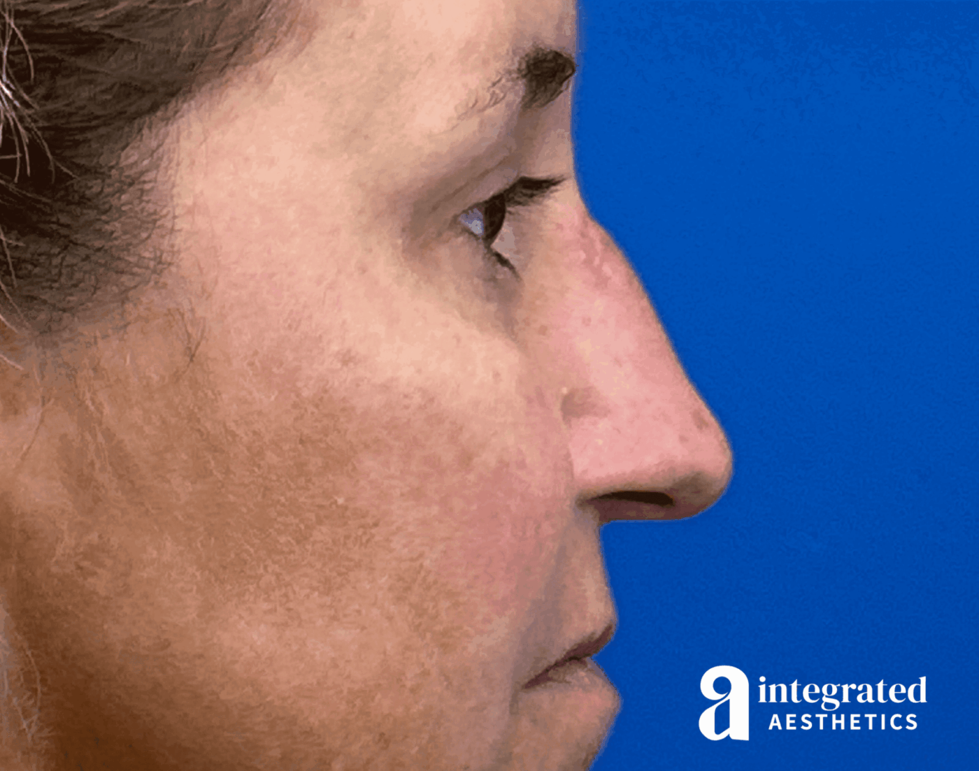 Rhinoplasty