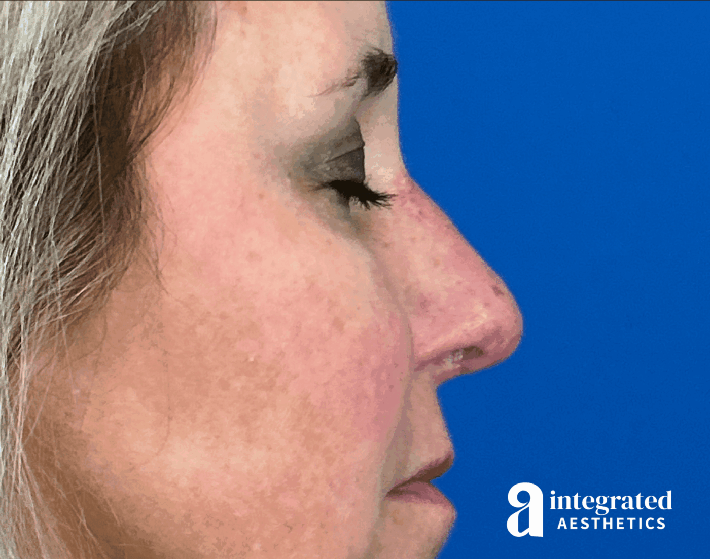Rhinoplasty
