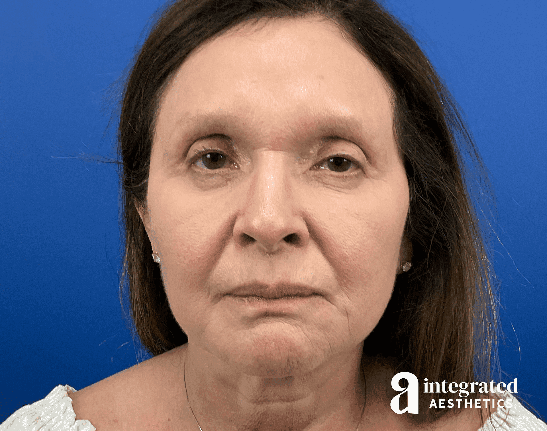 Facelift & Neck Lift